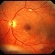 CMV Retinitis